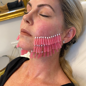 Dr Tass - Thread Lifts - Face