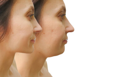 What Does Cools Sculpting Do?
