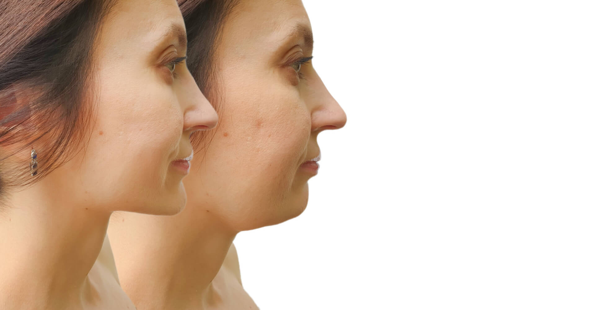 double chin removal
