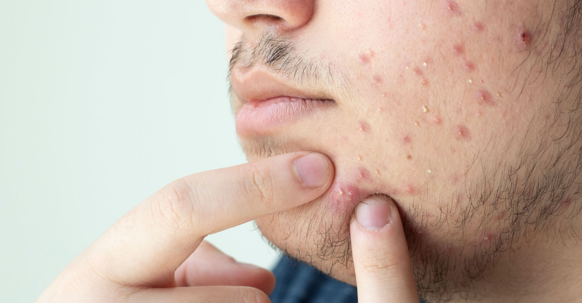 dermal fillers