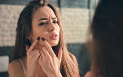 Treating Acne Scarring with Skin Boosters in Melbourne