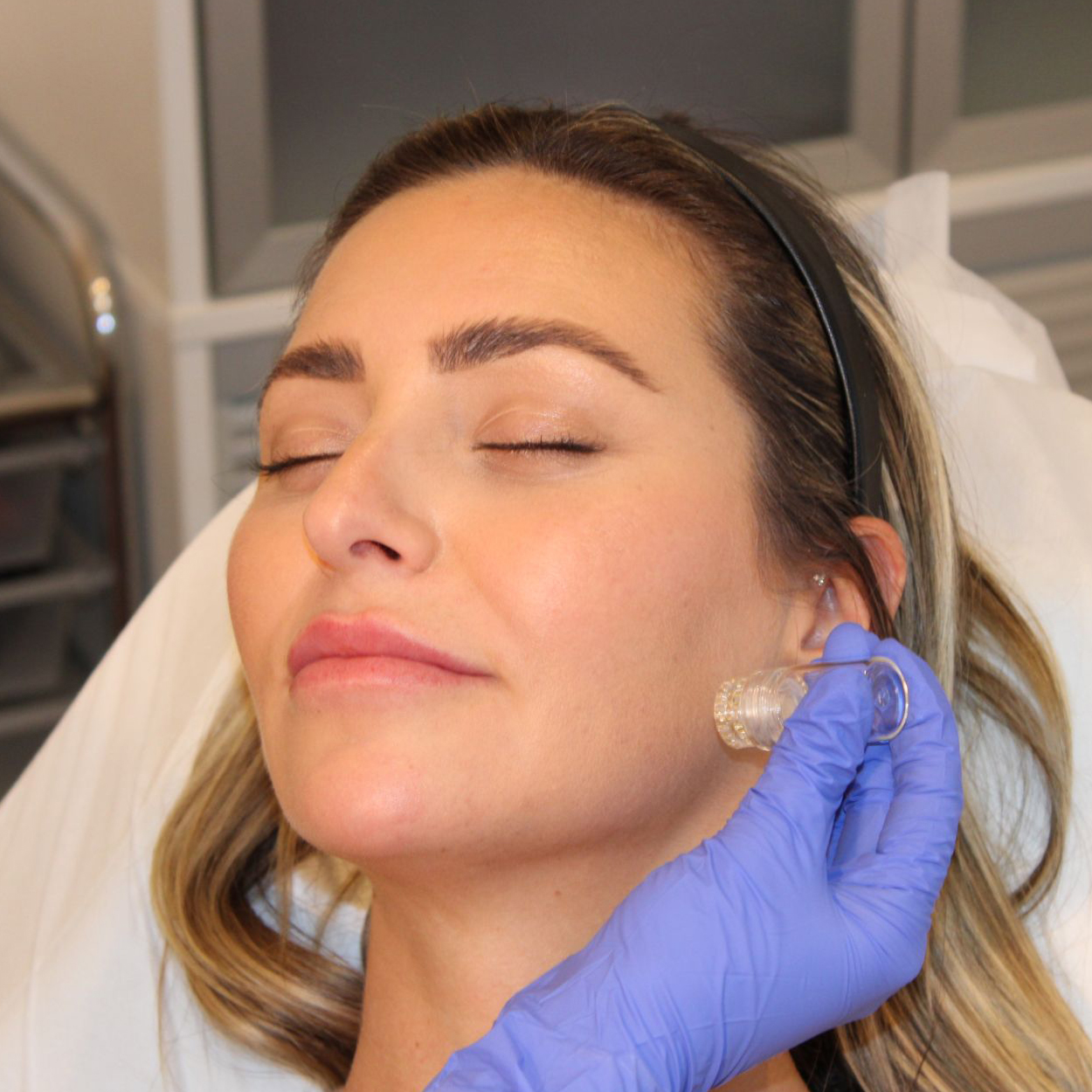Laser Skin Treatment in Melbourne