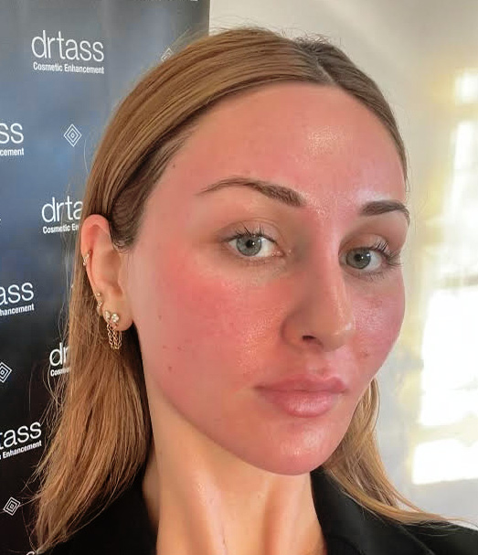 microdermabrasion melbourne