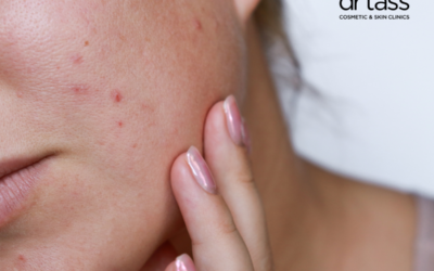 Fraxel Laser for Acne Scars, Sun Damage & Ageing Skin