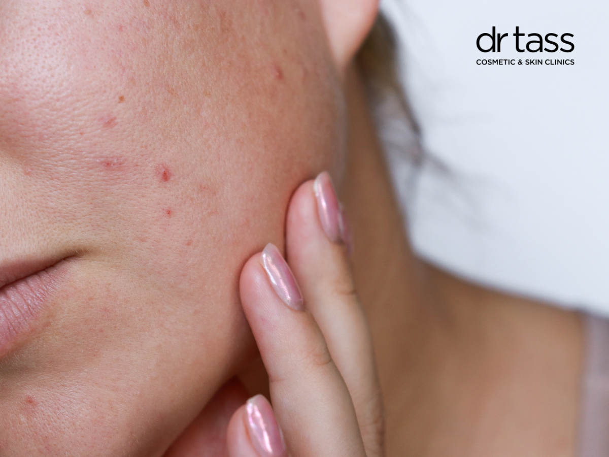 Ultherapy